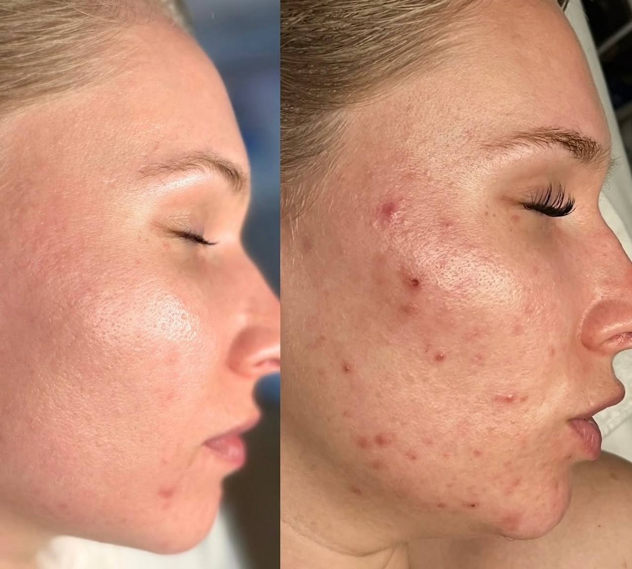 Acne treatment results
